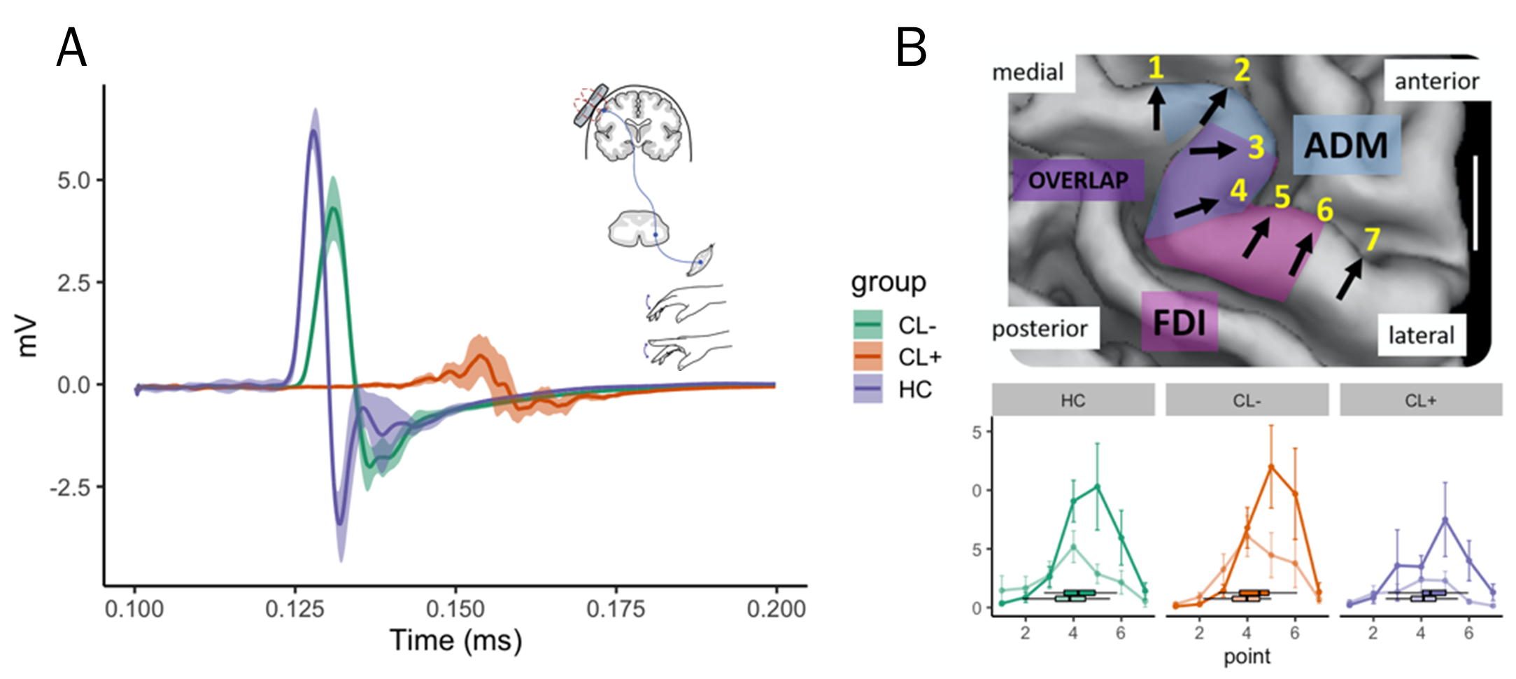 Figure 2: (A) The three motor evoked potentials (MEP) traces show that the onset latency was longer and lower in amplitude for both relapsing remitting MS patients compared to a healthy control (HC), but much more so in the patient with cortical damage (CL+). (B) TMS motor mapping successfully separates the representation of the FDI (bold) and ADM (faded color) muscle in all three groups.