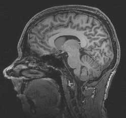 What is MRI